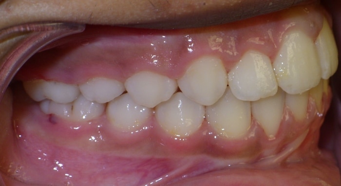before and after Richmond orthodontist
